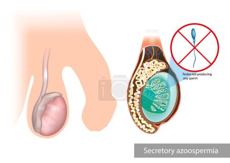 Illustration for Secretory or Non-Obstructive Azoospermia.Testes not producing any sperm. No production of spermatozoa. Testicular problems - Royalty Free Image