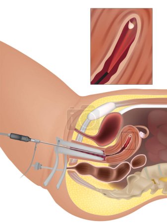 Ilustración de Pólipos uterinos o pólipos endometriales. Procedimiento de histeroscopia diagnóstica - Imagen libre de derechos