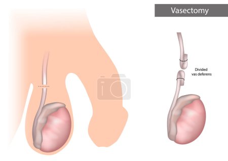 Illustration for Vasectomy. Divided vas deferens. Surgical procedure for male sterilization. Prevention of unwanted pregnancy - Royalty Free Image