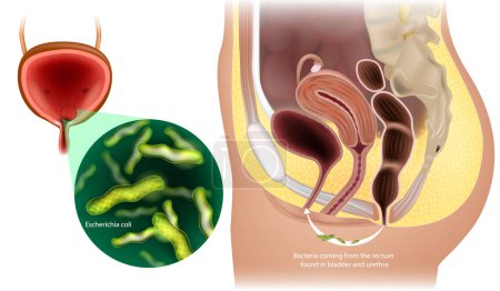 Illustration for Urinary Tract Infections in Women. Bacteria coming from the rectum found in bladder and urethra. Abacterial cystitis. Escherichia coli. - Royalty Free Image