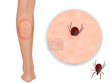 Téléchargez les illustrations : La maladie de Lyme ou borréliose de Lyme, est une maladie causée par la bactérie Borrelia. Érythème migrant. Vecteur - en licence libre de droit