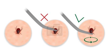 Illustration for Instructions for removing a tick with tweezers. Extraction of mites. Tick removing. Vector - Royalty Free Image