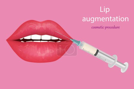 Illustration for Procedure lip augmentation. Cosmetic procedure that modifies the shape of the lips using fillers. Beauty Injection For Lips. - Royalty Free Image