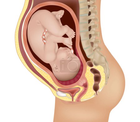 Ilustración médica Placenta total previa. Previo completo