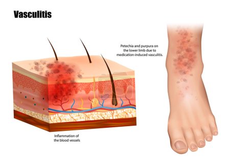 Illustration for Vasculitis involves inflammation of the blood vessels. Petechia and purpura on the lower limb due to medication-induced vasculitis. Lymphangitis - Royalty Free Image