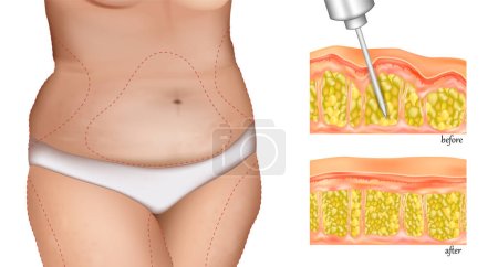 Illustration for Illustration of liposuction intervention in a woman. LIPOSCULPTURE procedure or LIPOMODELLING. Plastic surgery technique. - Royalty Free Image