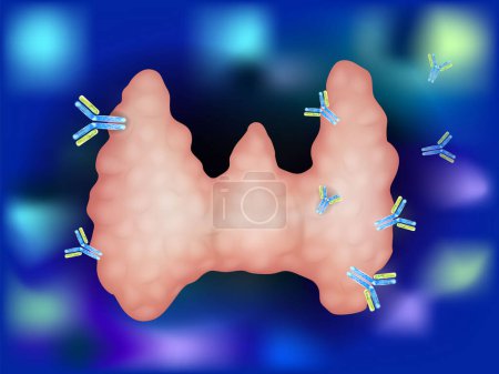 Téléchargez les illustrations : Illustration montrant des anticorps attaquant la glande thyroïde. Thyroïdite auto-immune, maladie de Hashimoto. Auto-immunité - en licence libre de droit