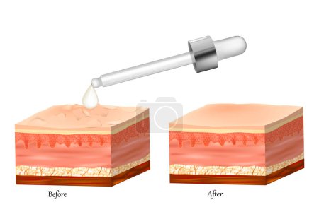 Illustration for Realistic vector illustration with Healthy and damaged skin. Hydrated and dry skin. Cross section of a skin layers epidermis and dermis. Care rejuvenation of the skin. - Royalty Free Image