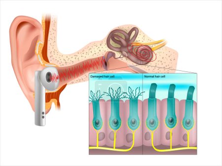 Ilustración de Células pilosas sanas y dañadas dentro de la cóclea. Pérdida auditiva inducida por ruido. Tinnitus. - Imagen libre de derechos