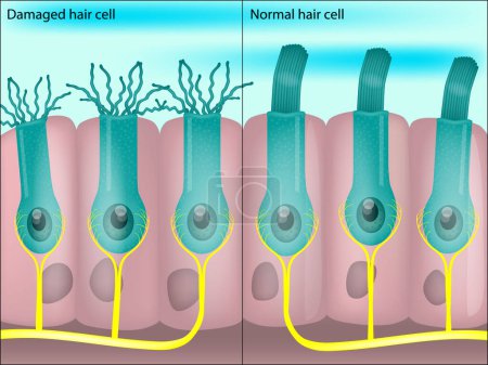 Healthy and damaged hair cells inside cochlea. Noise-induced hearing loss. Tinnitus.