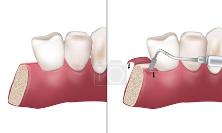 Illustration for Mid-crestal incision used during implant bed preparation. Paracrestal Incision. Flap Techniques in Dentoalveolar Surgery. Periodontal - Royalty Free Image