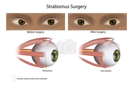 Illustration for Strabismus or Squint surgery treats misaligned eyes. Eye Muscle Surgery. Ophthalmology - Royalty Free Image