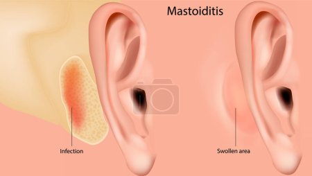 Illustration for Mastoiditis. Inflammation of the mucosal lining of the mastoid antrum and mastoid air cell system inside the mastoid process. - Royalty Free Image