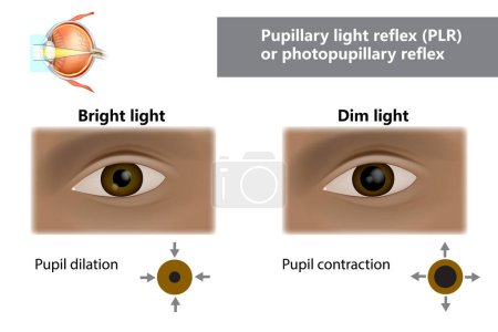 Ilustración de Reflejo de luz pupilar RLP o reflejo fotopupilar. ¿Cómo cambian de tamaño las pupilas con luz tenue y brillante? Función del iris y la pupila - Imagen libre de derechos