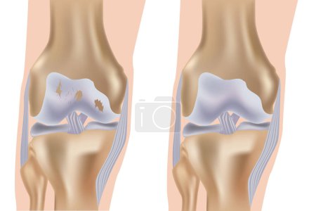 Illustration for Knee arthrosis. Medical vector illustration with damaged knee structure and healthy knee comparison. - Royalty Free Image
