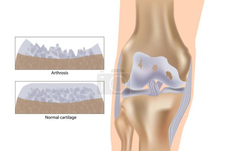 Ilustración de Artrosis de rodilla. Ilustración de vectores médicos con estructura de rodilla dañada y comparación de rodilla saludable. - Imagen libre de derechos