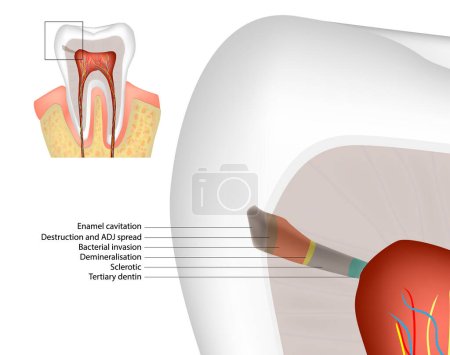 Téléchargez les illustrations : Histopathology of Caries in Enamel and Dentine. Enamel Dentin Pulp complex. Diagramme Caries dentaires. Dentine tertiaire - en licence libre de droit