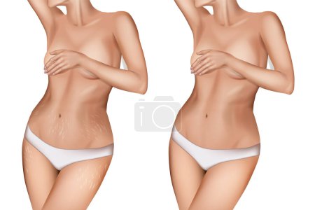 Illustration for Stretch marks, also known as striae or striae distensae. Striae are caused by tearing of the dermis. Before and After - Royalty Free Image