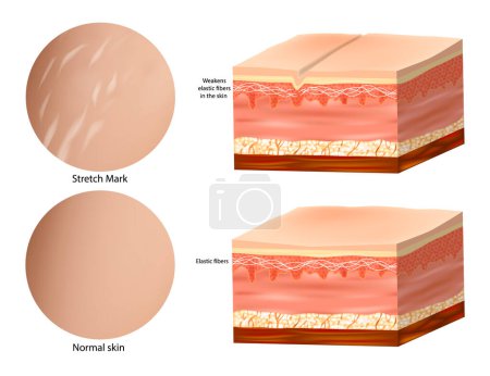 Ilustración de Anatomía médica Marcas de estiramiento de la piel. Elastina de colágeno. Piel normal y marca de estiramiento - Imagen libre de derechos