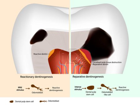Schematic diagram of tertiary dentin formation. Reparative dentinogenesis and Reactive dentinogenesis. Odontoblast and Dental pulp stem cell