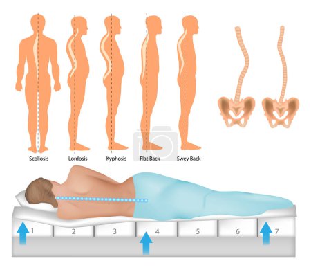 Illustration for Orthopedic Mattress. Curvature Of Human Spine. The Influence of Mattress Stiffness on Spinal Curvature and Intervertebral Disc Stress. - Royalty Free Image