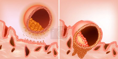 Téléchargez les illustrations : Le processus pendant l'implantation embryonnaire. Le blastocyste implante dans l'endomètre maternel. Blastocyste. Apposition et adhésion - en licence libre de droit