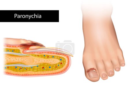 Paronychie ist eine Entzündung der Haut rund um den Nagel. Nagelentzündung
