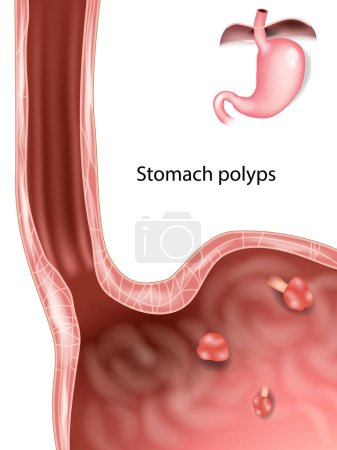Polypes dans l'estomac. Polype gastrique. Illustration médicale de l'estomac