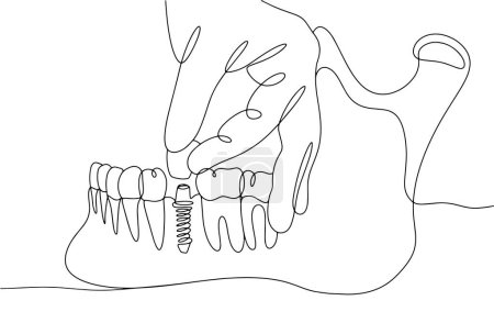Illustration for Implantation of a tooth in the lower jaw of a person. The work of a dental technician. European Dental Technicians Day. One line drawing for different uses. Vector illustration. - Royalty Free Image