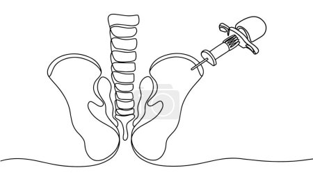 Puncture of the bone marrow from the posterior iliac crest of the pelvis. World Marrow Donor Day. One line drawing for different uses. Vector illustration.