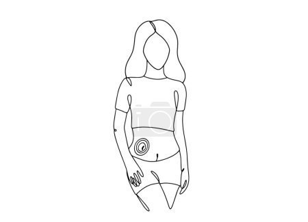 Illustration for Woman with a stoma. Ostomy patient. Ostomy Awareness Day. One line drawing for different uses. Vector illustration. - Royalty Free Image