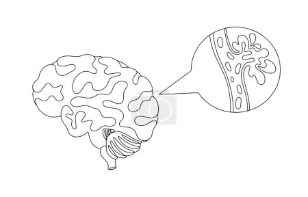 Illustration for Hemorrhagic stroke. Poor circulation with rupture of the vessel wall. Hemorrhage in the brain. World Stroke Day. One line drawing for different uses. Vector illustration. - Royalty Free Image