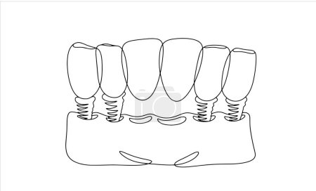 Téléchargez les illustrations : Pont dentaire pour 6 dents. Restauration esthétique de la dentition. Un dessin de ligne pour différentes utilisations. Illustration vectorielle. - en licence libre de droit