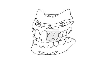 Illustration for Implantation of a denture on the upper jaw. Prosthetics of the upper dentition. Three-quarter jaw rotation. One line drawing for different uses. Vector illustration. - Royalty Free Image