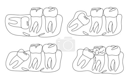 Illustration for Options for placement of wisdom teeth. Incorrect tooth growth. Impacted tooth. One line drawing for different uses. Vector illustration. - Royalty Free Image