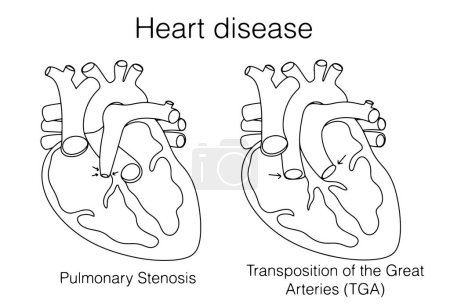 Illustration for Pulmonary Stenosis and Transposition of the great arteries. Line medical illustration with types of heart defects. Vector. Images produced without the use of any form of AI software at any stage. - Royalty Free Image