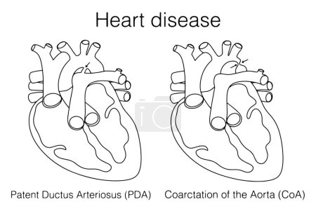 Illustration for Patent Ductus Arteriosus and Coarctation of the aorta. Types of heart defects. Congenital defects of the heart muscle. Images produced without the use of any form of AI software at any stage. - Royalty Free Image