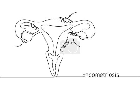 Illustration for The female disease endomitriosis. Uncontrolled growth of epithelium outside the uterus. Medical illustration with line. Images produced without the use of any form of AI software at any stage. - Royalty Free Image