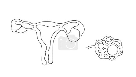 Uterus with an ovarian cyst and a multifollicular ovary nearby. Disease of the female reproductive system. Vector. Images produced without the use of any form of AI software at any stage. 