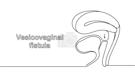 Newly formed pathological communication between the vagina and urinary tract. Complication after childbirth. Vector illustration.