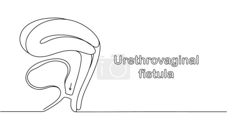 A fistula connecting the vagina and urethra. Obstetric fistula. Medical illustration with line.