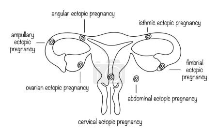 Tipos de embarazo ectópico. Embarazo cuando el óvulo no se implanta en el útero. Línea de ilustración médica con leyendas.