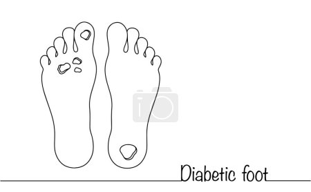Pie diabético. Complicación grave de la diabetes mellitus. lesión necrótica ulcerativa de los pies humanos. Ilustración médica para educar a la gente sobre el problema de la diabetes.