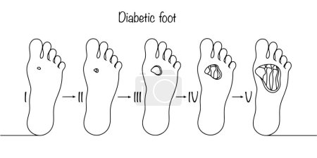 Stages of ulcerative-necrotic destruction of deep tissues of the human foot. Severe complication of diabetes. Hand drawn medical illustration.