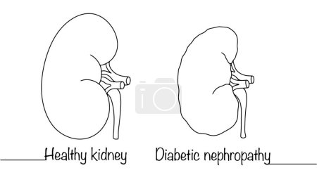 Un riñón de una persona sana y un riñón de una persona con diabetes. Complicación de la diabetes. Ilustración médica línea dibujada a mano.