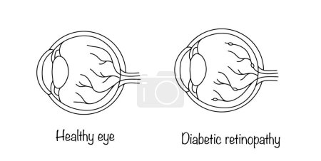 The eyeball of a healthy person and a person with diabetes. Damage to the retina of the eye, which is one of the most severe forms of complications of diabetes mellitus. Isolated vector.