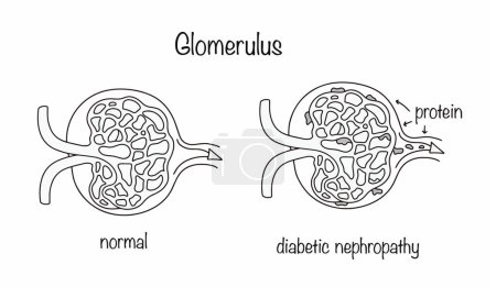 Healthy and diseased glomerulus. Impaired blood filtration in the tubules and glomeruli of the nephron. Diabetic nephropathy. A simple medical illustration on the topic of complications of diabetes.