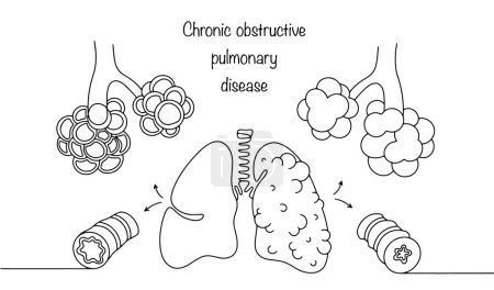 Human lungs with signs of obstruction in the alveoli and bronchi on one side, and healthy ones on the other side. Human respiratory tract disease. Vector illustration.