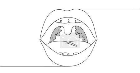 Offener Mund eines Mannes mit isolierten Mandeln. Eine Ansammlung von Lymphgewebe, das sich auf beiden Seiten des Eingangs in den Rachen befindet. Schwarz-Weiß-Illustration zu einem medizinischen Thema.
