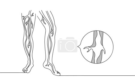 Illustration for Ischemia of the lower extremities. A pathological condition in which blood flow in the vessels is disrupted in the legs. Dangerous disease. influencing people's lives. Isolated vector. - Royalty Free Image
